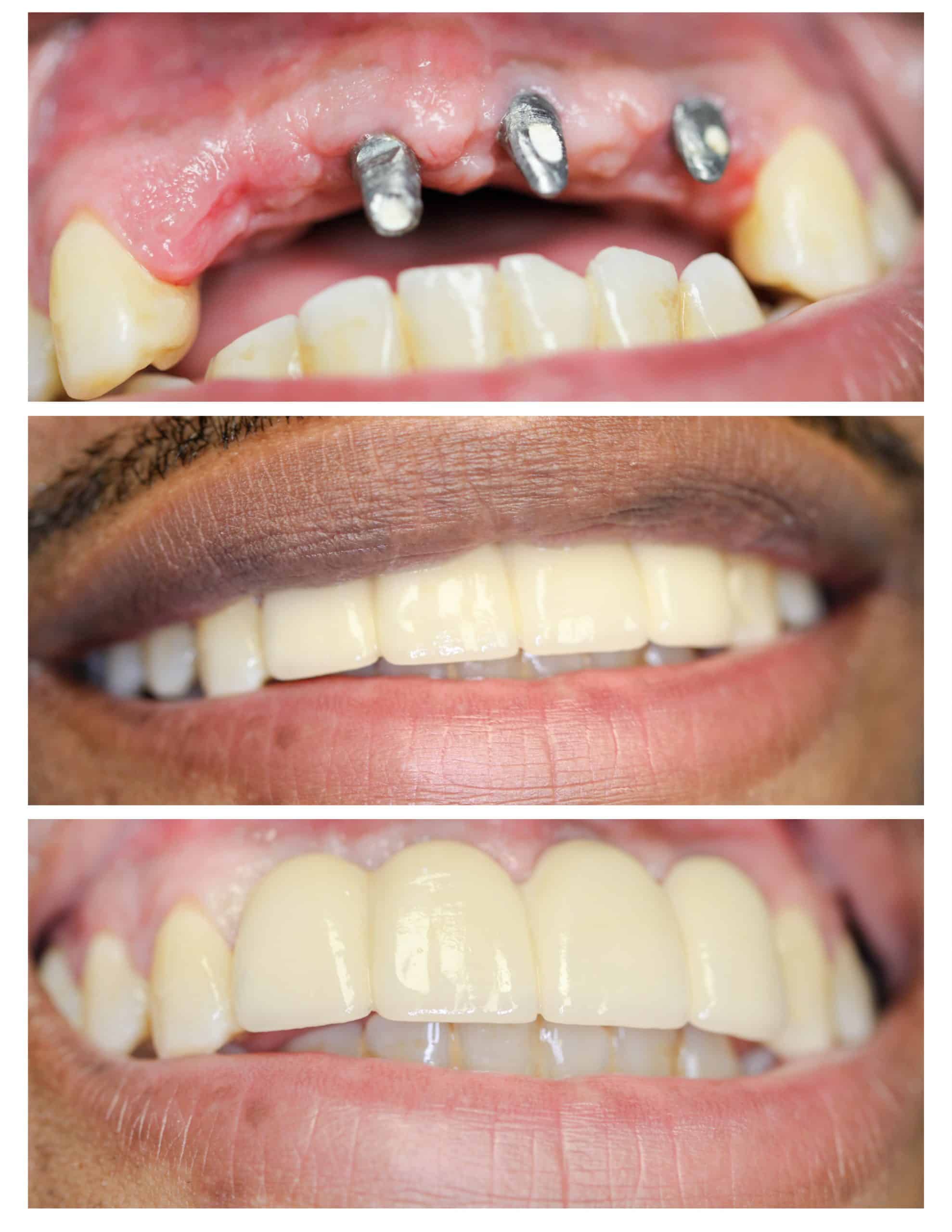 Illustrative example of dental implants posts from Google Search