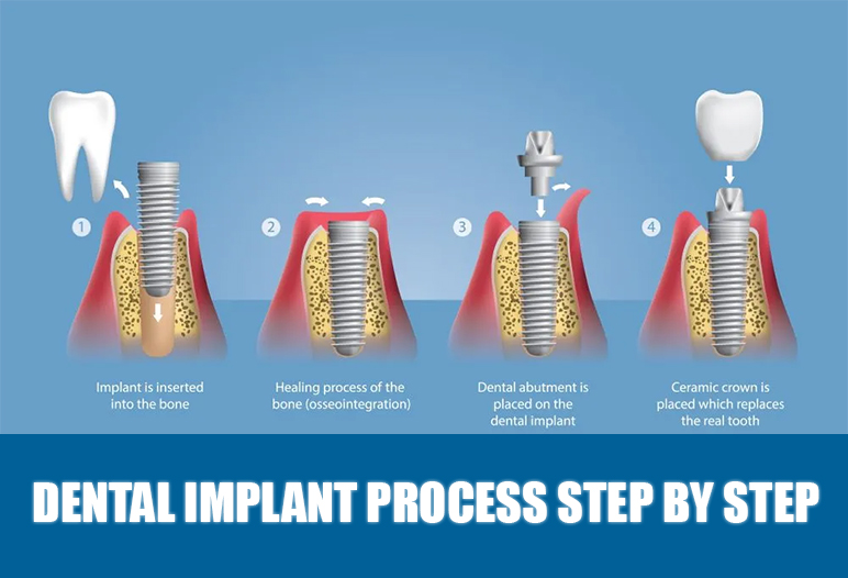Illustrative example of dental implants procedure step by step from Google Search