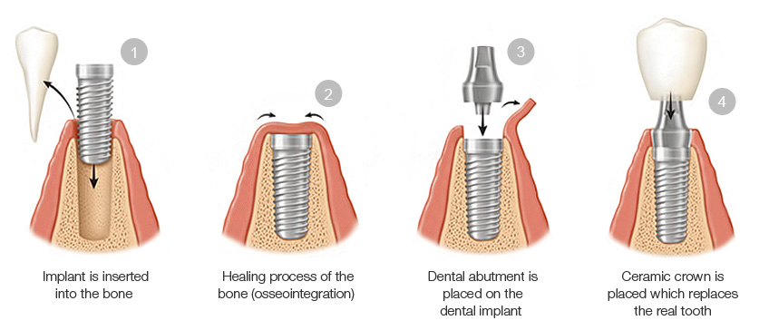 Illustrative example of dental implants process step by step from Google Search