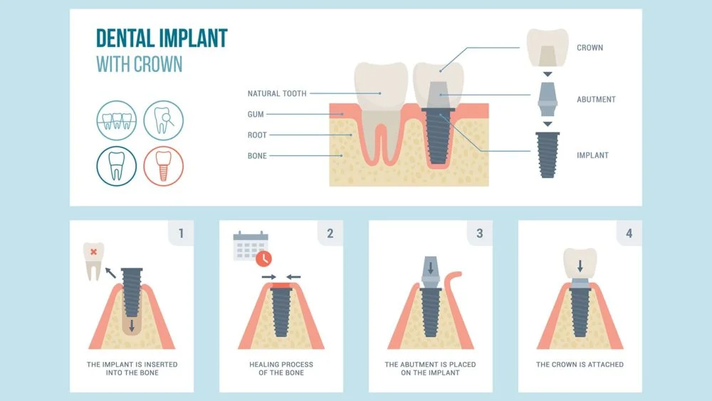 Illustrative example of dental implants process step by step from Google Search