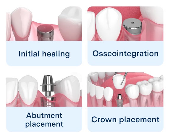 Illustrative example of dental implants recovery from Google Search