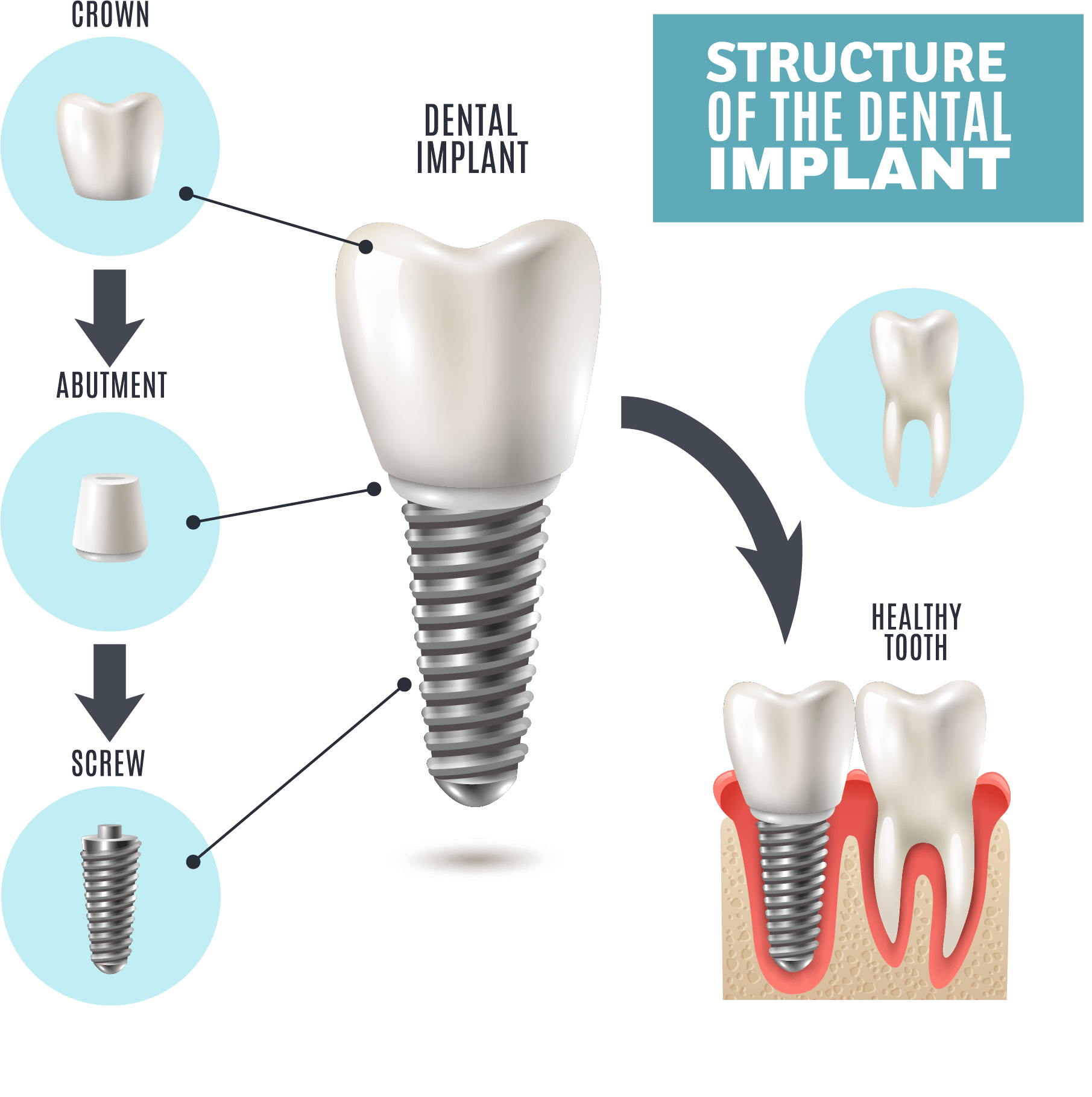 Illustrative example of dental implants screw from Google Search
