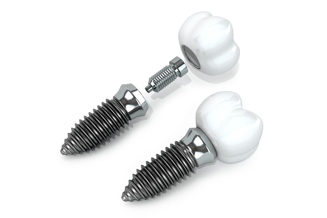 Illustrative example of dental implants screw from Google Search