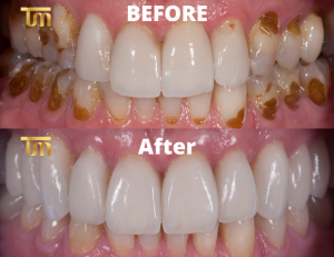 Illustrative example of dental implants veneers from Google Search