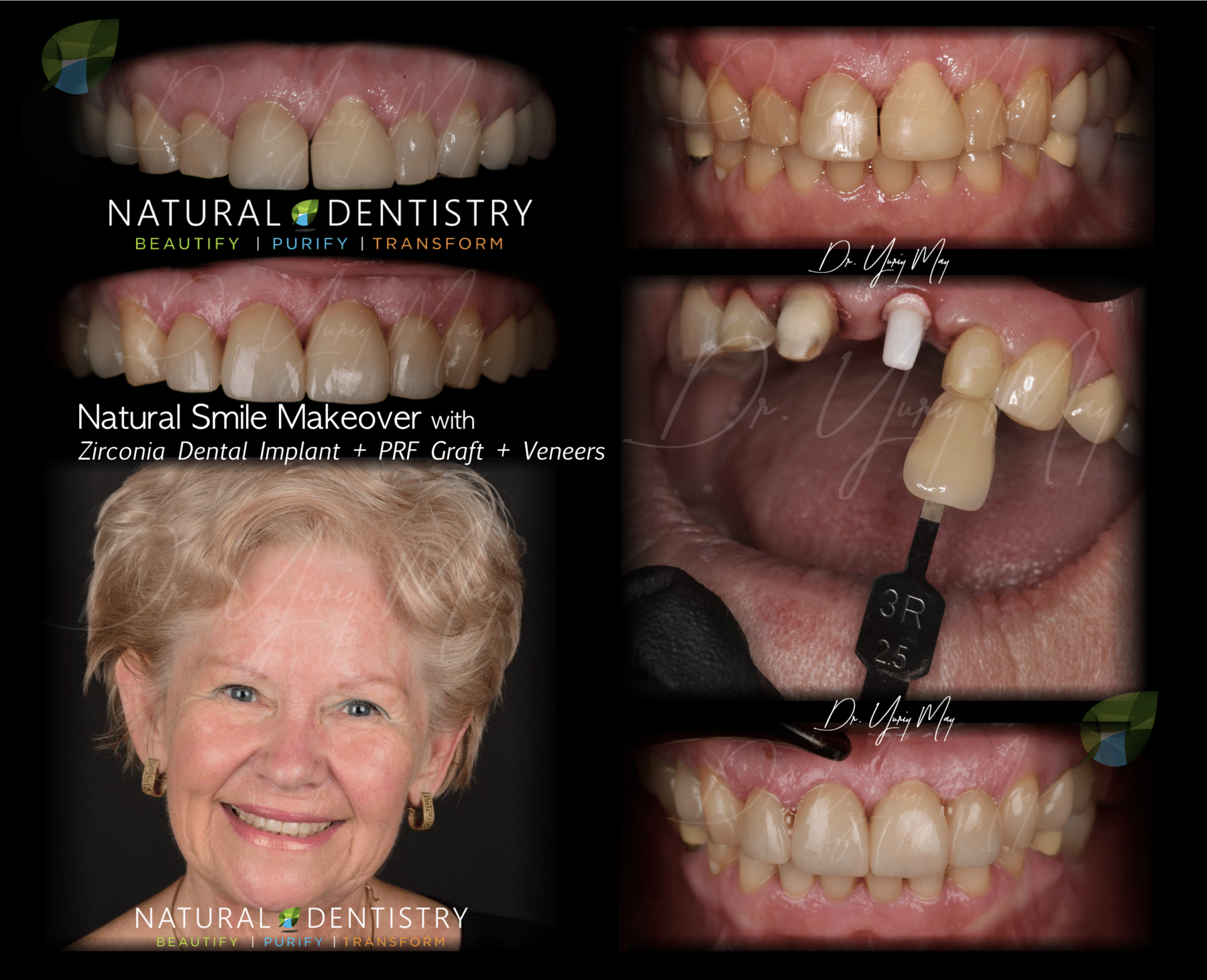 Illustrative example of dental implants veneers from Google Search