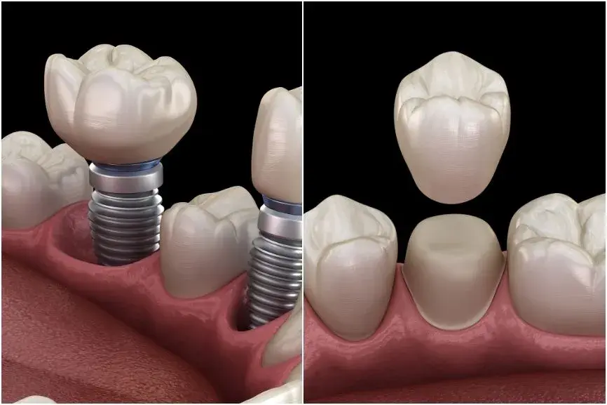 Illustrative example of dental implants versus crowns from Google Search