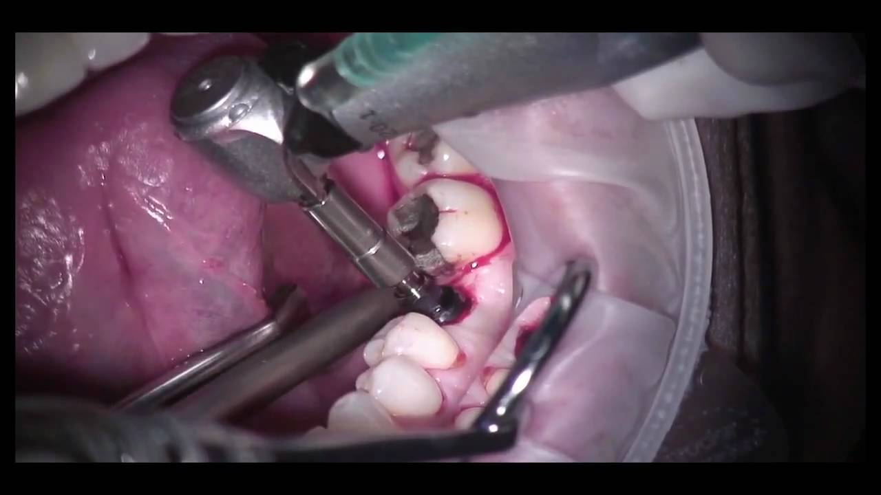Illustrative example of dental implants video from Google Search