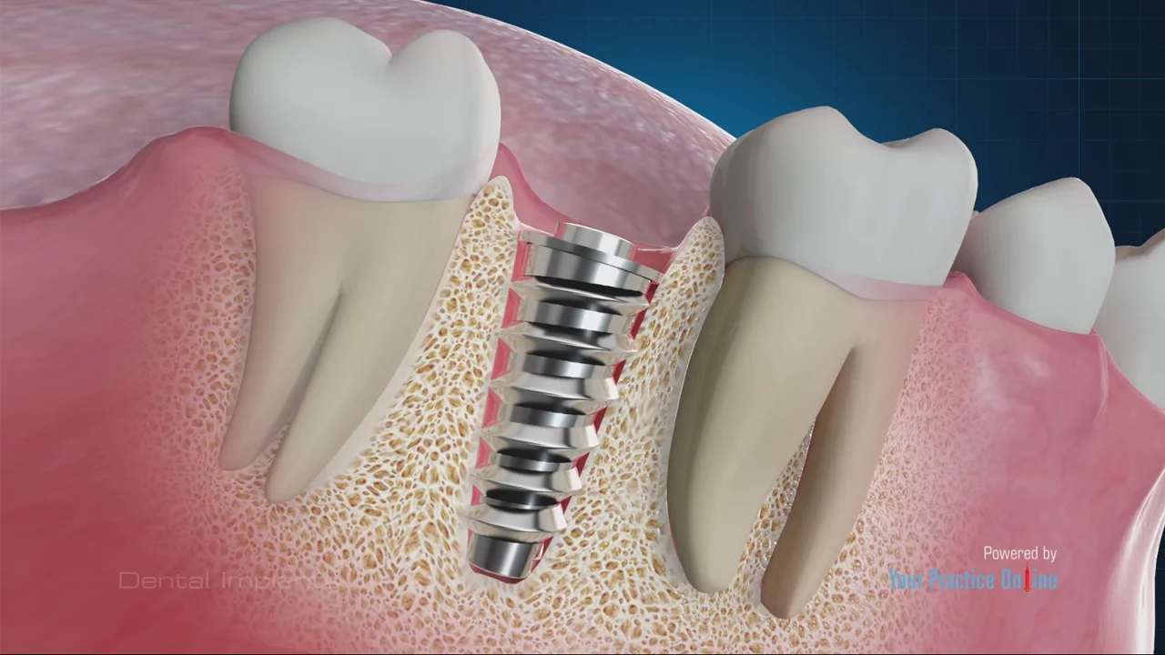Illustrative example of dental implants video from Google Search
