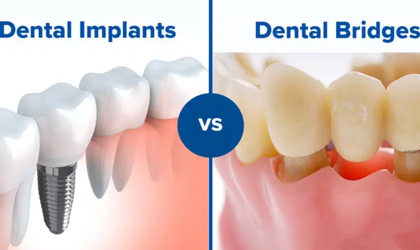 Illustrative example of dental implants vs a bridge from Google Search