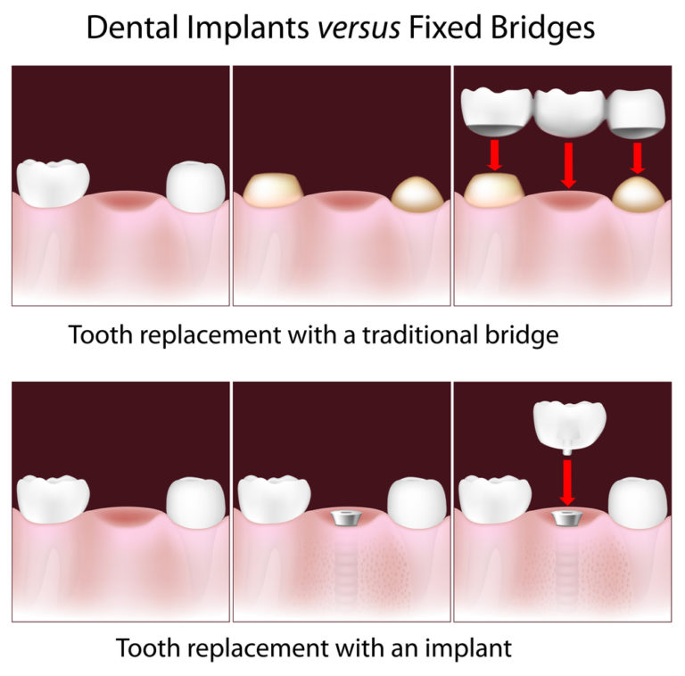 Illustrative example of dental implants vs a bridge from Google Search