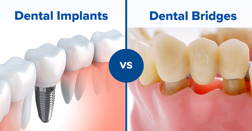 Illustrative example of dental implants vs crowns and bridges from Google Search