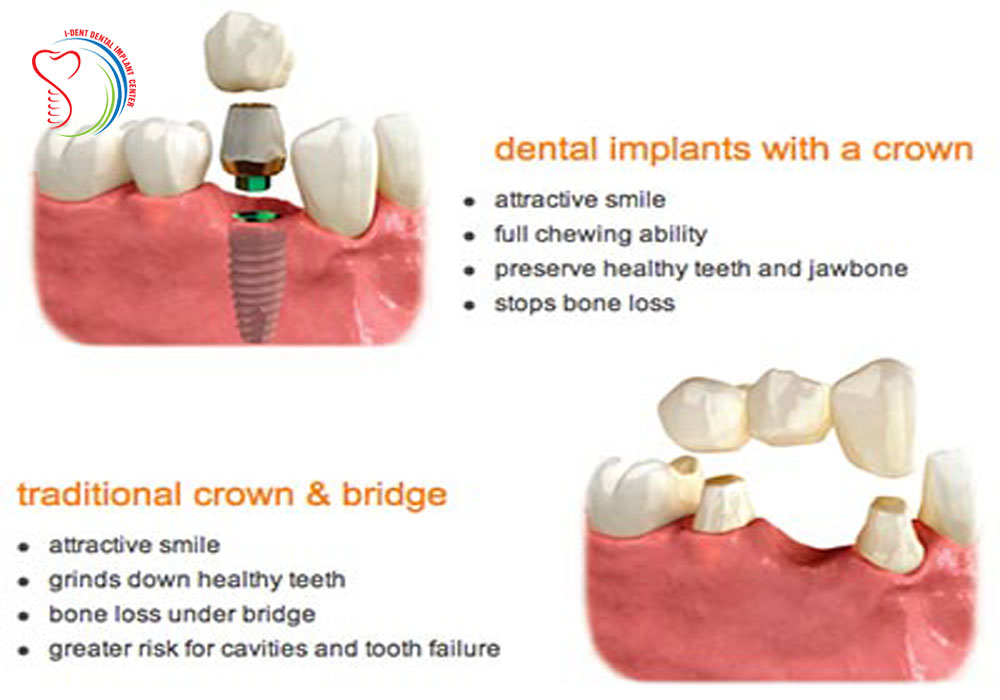 Illustrative example of dental implants vs crowns and bridges from Google Search