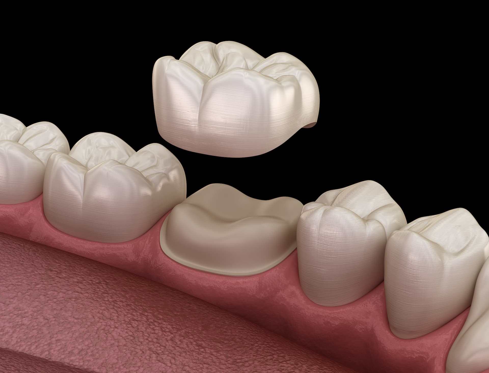 Illustrative example of dental implants vs crowns from Google Search