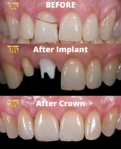 Illustrative example of dental implants vs crowns from Google Search