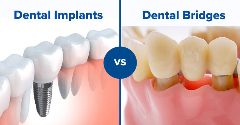 Illustrative example of dental implants vs partials from Google Search
