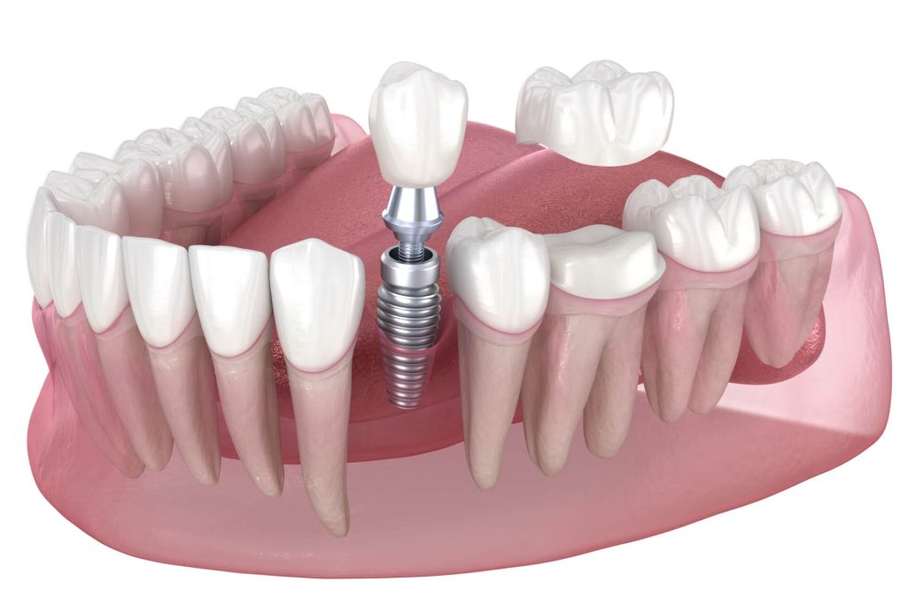 Illustrative example of dental implants vs veneers cost from Google Search