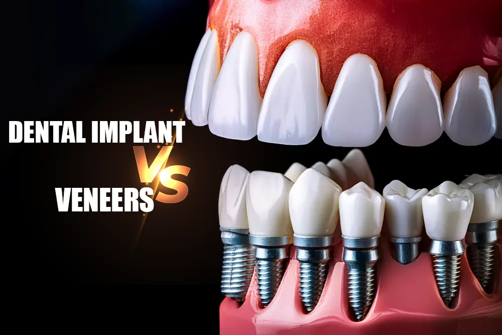 Illustrative example of dental implants vs veneers cost from Google Search
