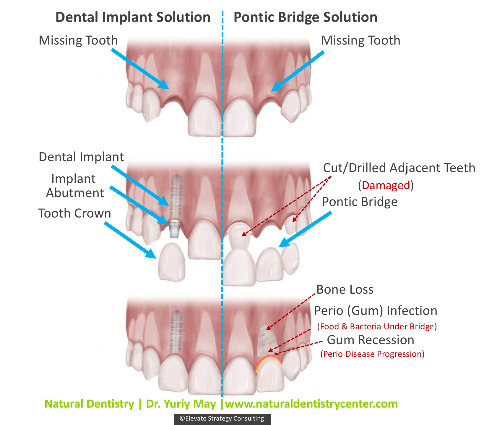 Illustrative example of dental implants with bone loss from Google Search