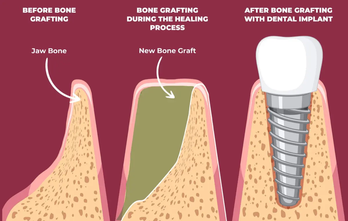 Illustrative example of dental implants with bone loss from Google Search