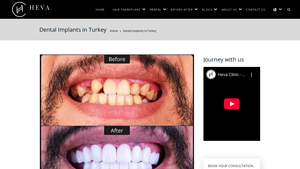 Dental Implants in Turkey - Procedure & Cost in 2025 - Heva Clinic - best dental implants in turkey cost