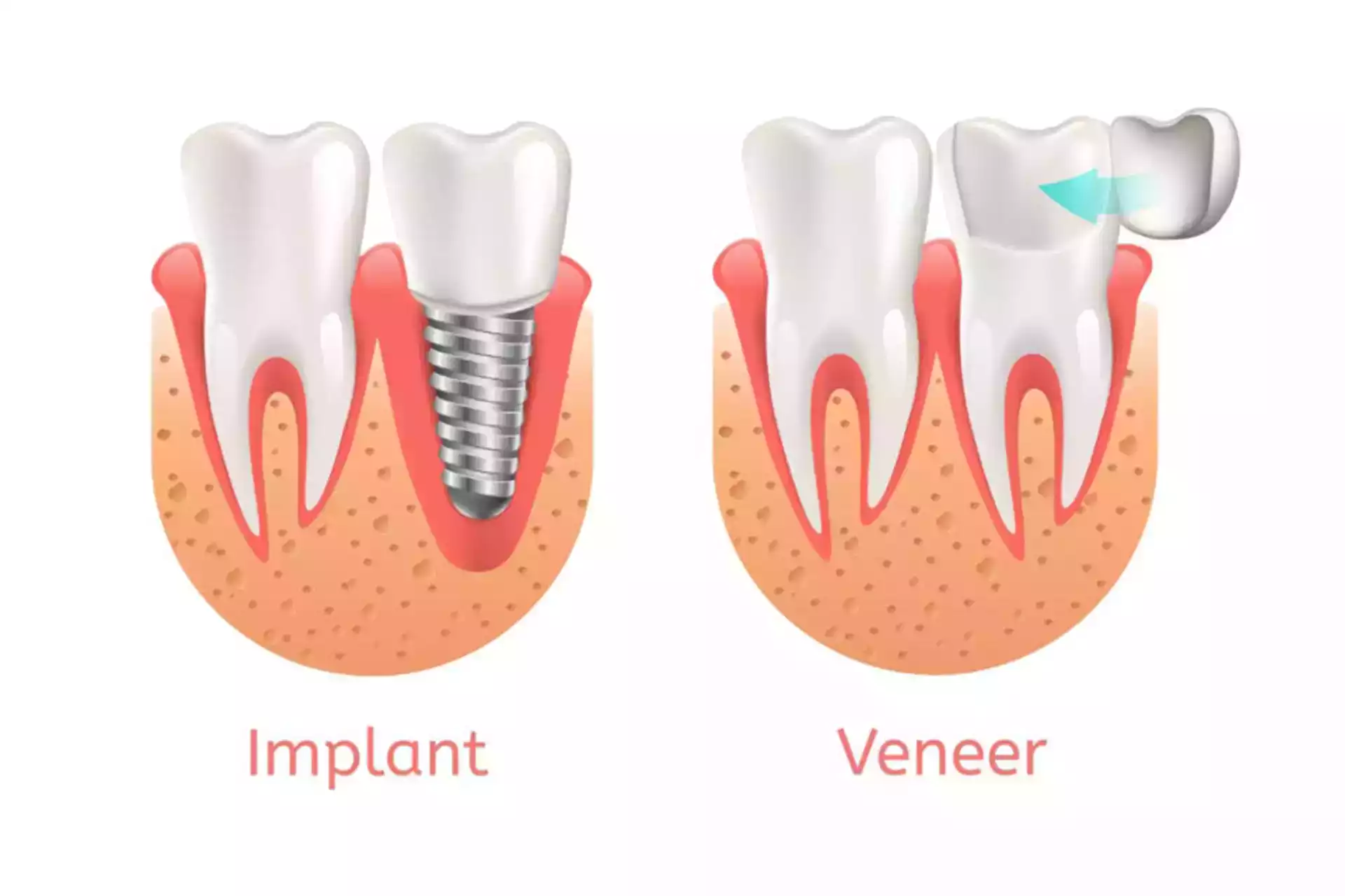 Illustrative example of difference between dental implants and veneers from Google Search