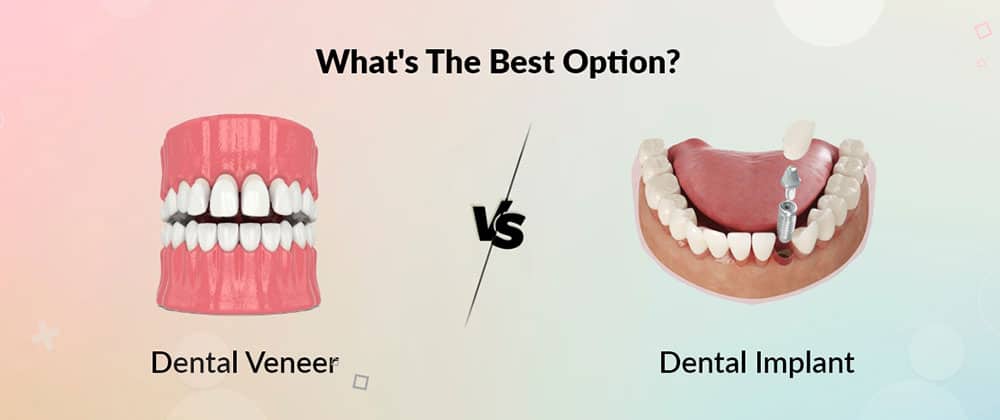 Illustrative example of difference between dental implants and veneers from Google Search