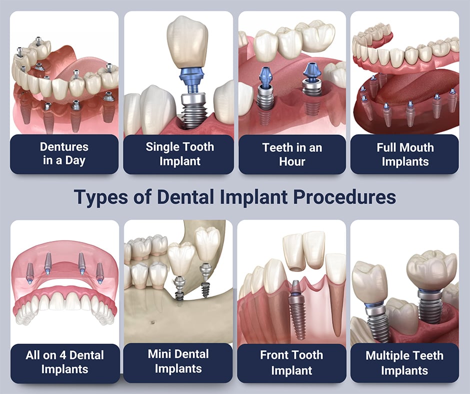 Illustrative example of different kinds of dental implants from Google Search