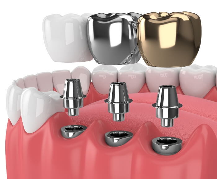 Illustrative example of different kinds of dental implants from Google Search