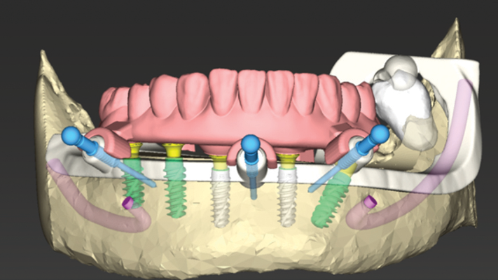 Illustrative example of digital dental implants from Google Search