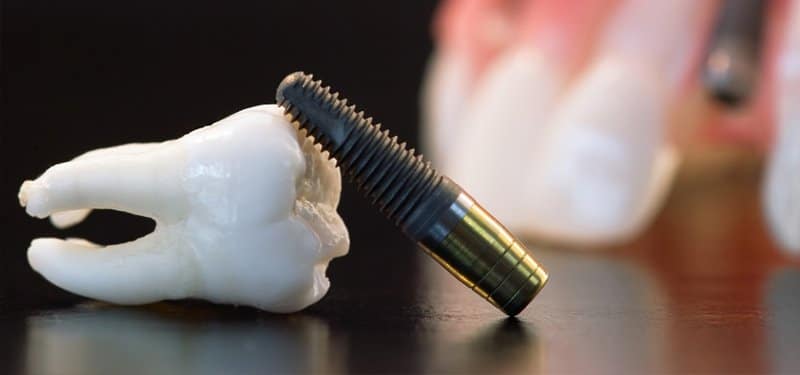 Illustrative example of disadvantage of dental implants from Google Search