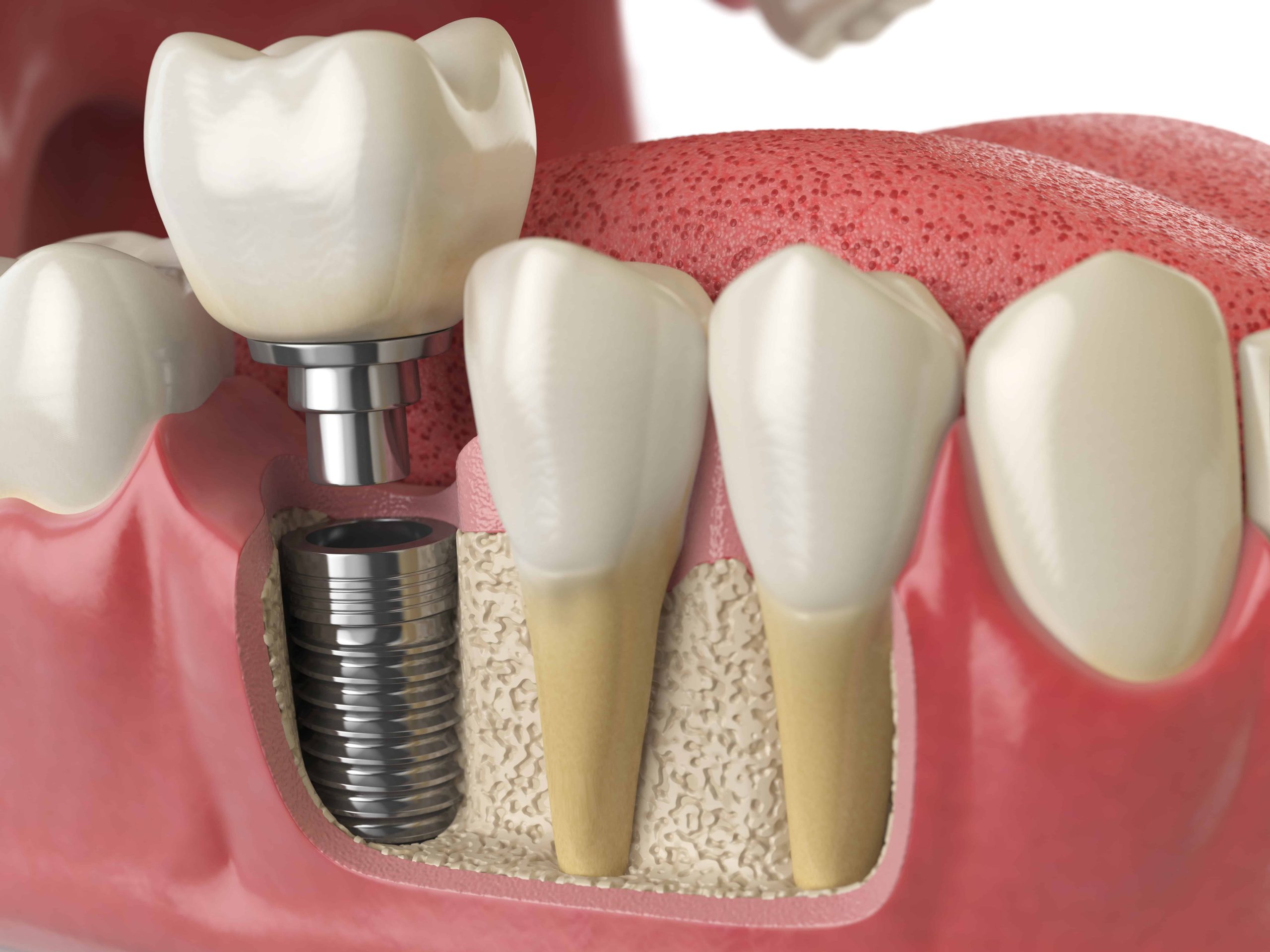 Illustrative example of endosteal dental implants from Google Search