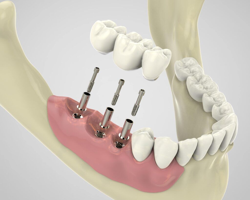 Illustrative example of endosteal dental implants from Google Search