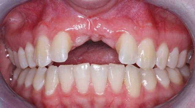 Illustrative example of failed dental implants from Google Search
