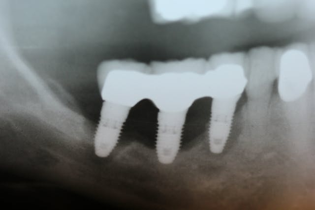 Illustrative example of failing dental implants from Google Search