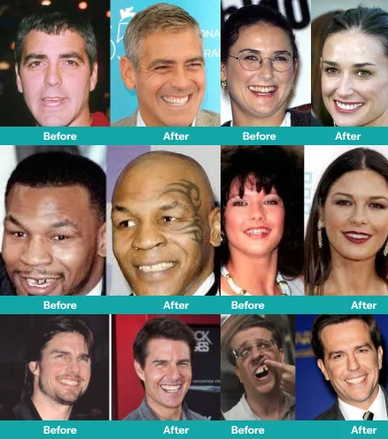 Illustrative example of famous celebrities with dental implants from Google Search