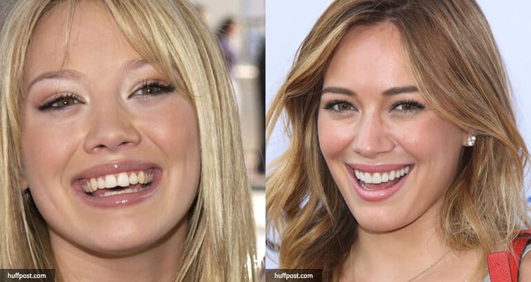 Illustrative example of famous people with dental implants from Google Search