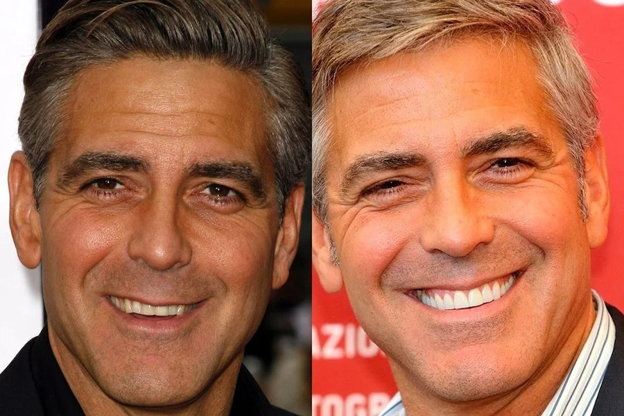 Illustrative example of famous people with dental implants from Google Search