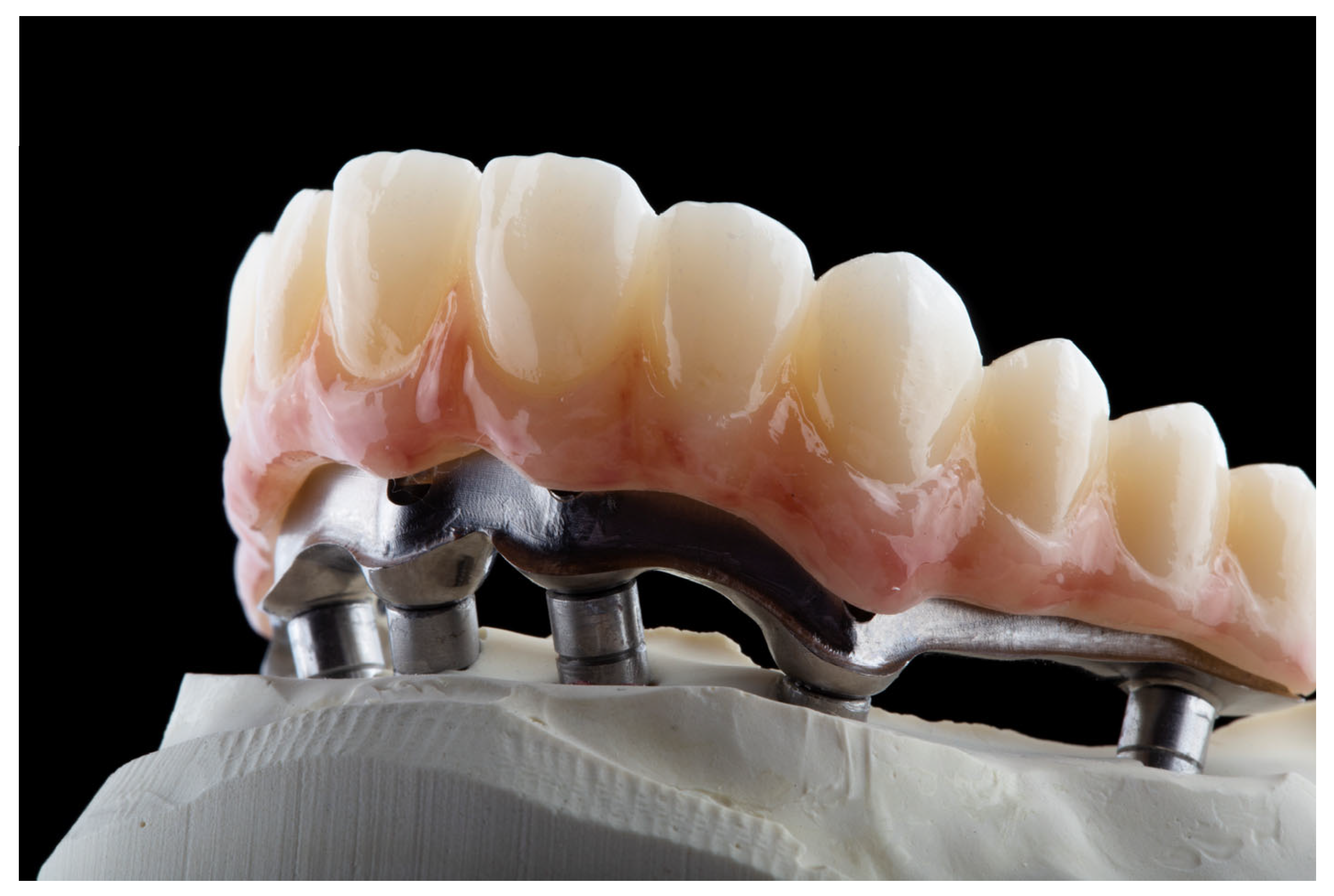 Illustrative example of fixed full arch dental implants from Google Search