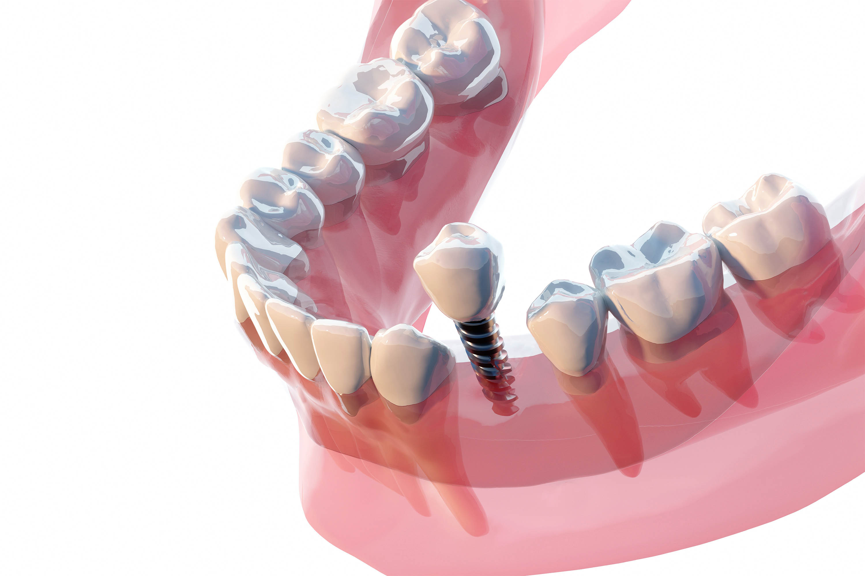 Illustrative example of fixing dental implants from Google Search