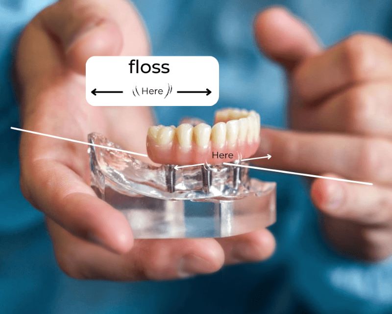 Illustrative example of floss dental implants from Google Search