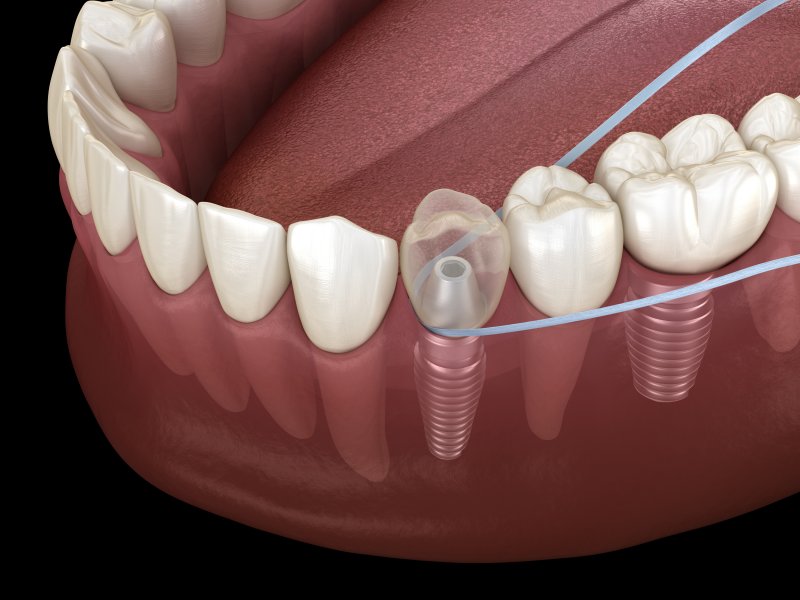 Illustrative example of floss dental implants from Google Search