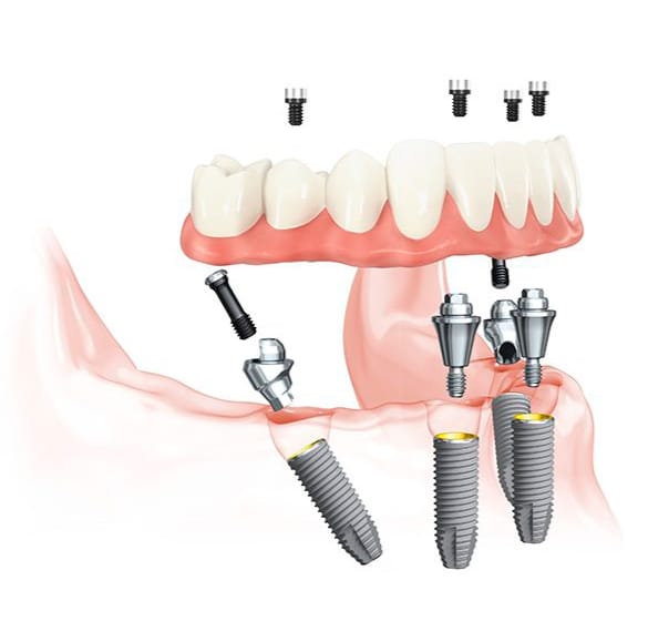 Illustrative example of four on one dental implants from Google Search