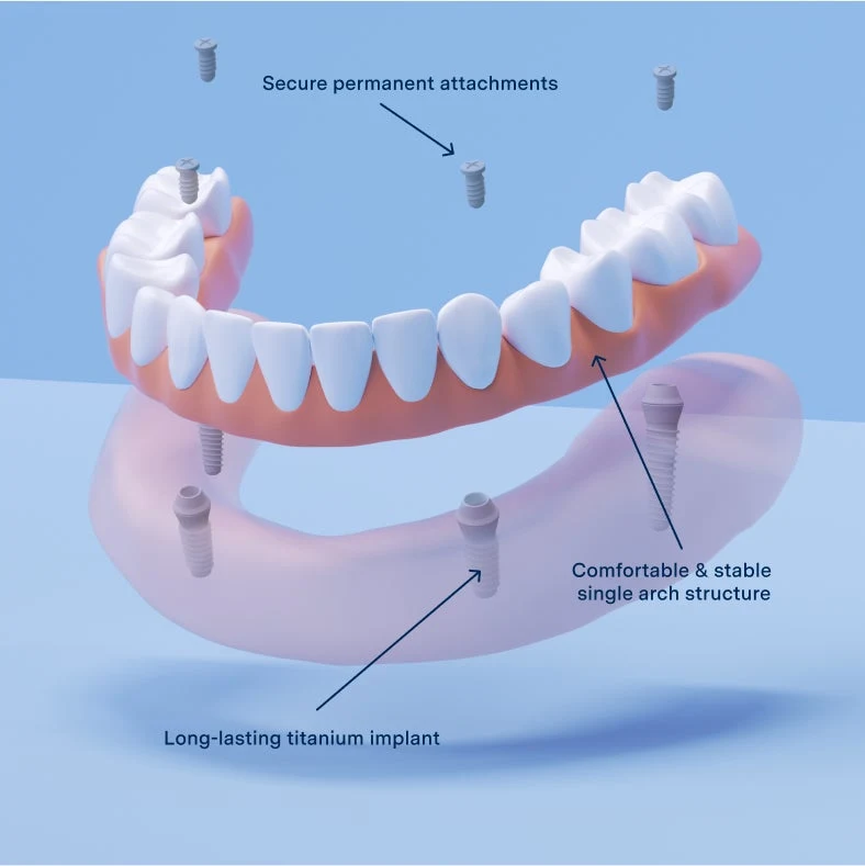 Illustrative example of full arch dental implants from Google Search