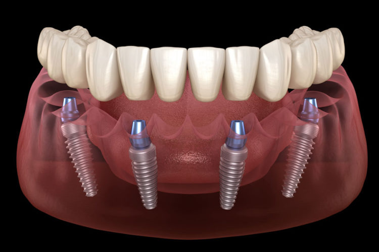 Illustrative example of full arch dental implants from Google Search