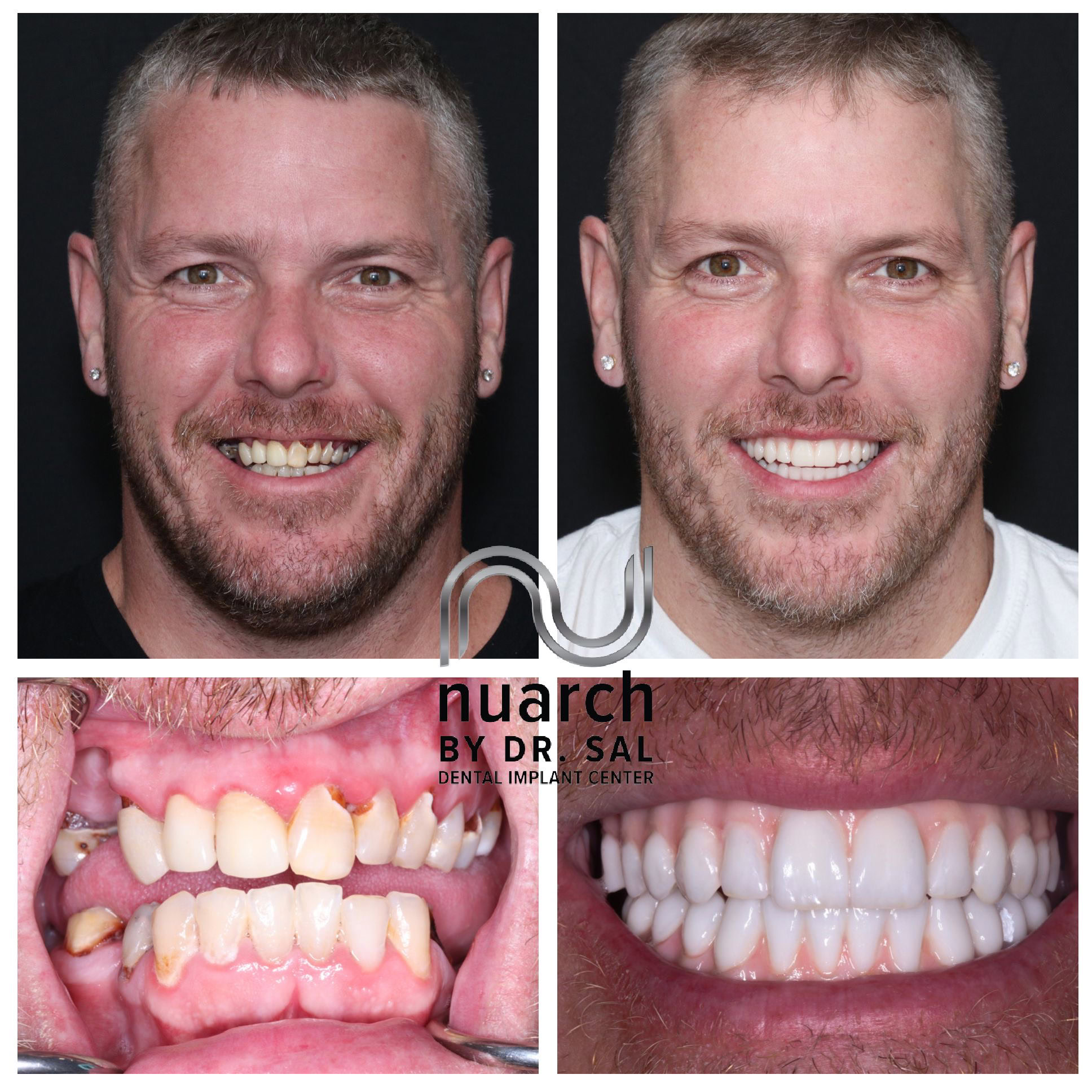 Illustrative example of full dental implants before and after from Google Search