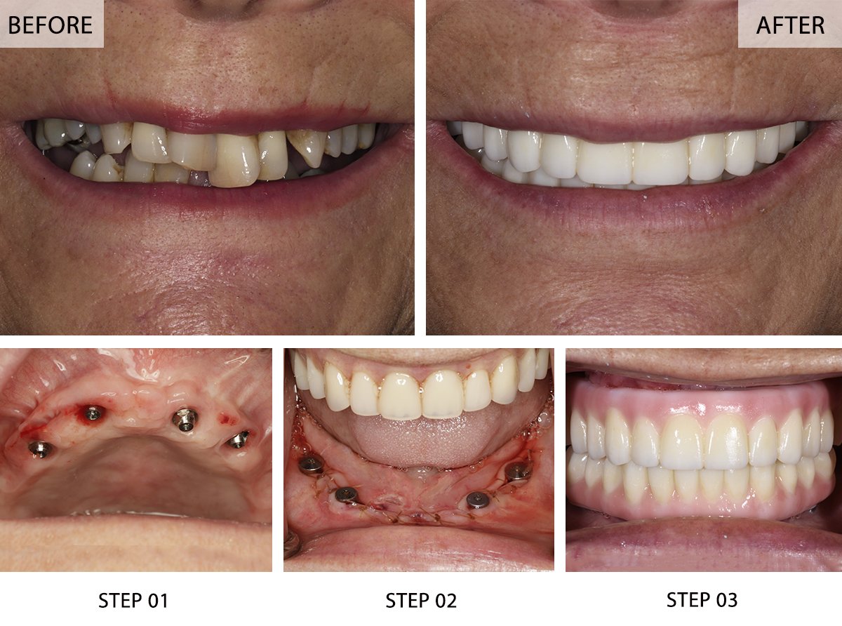 Illustrative example of full dental implants before and after from Google Search
