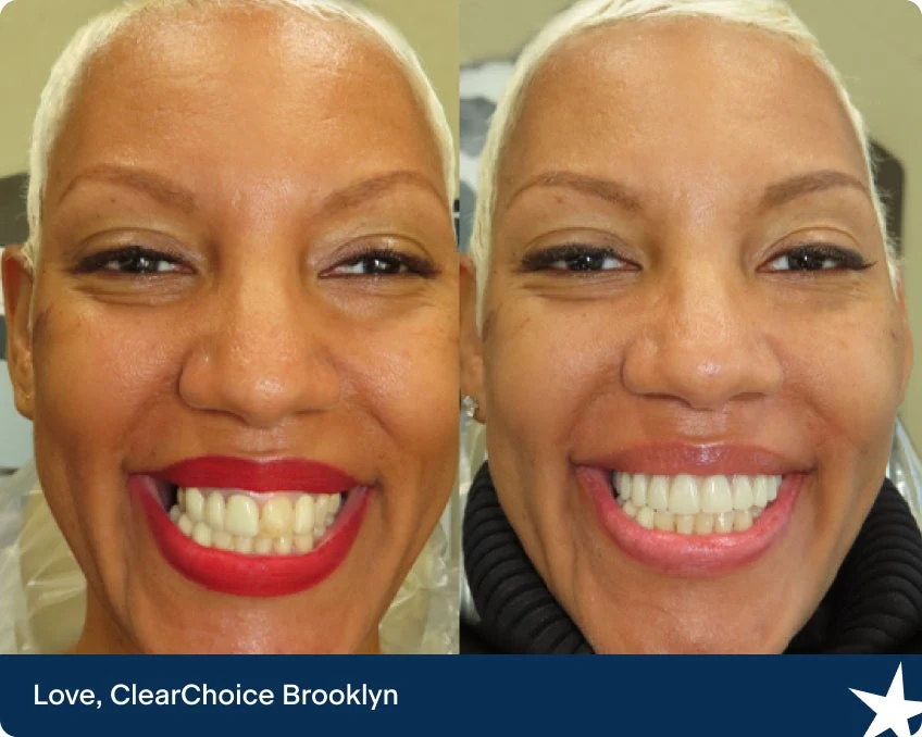 Illustrative example of full mouth dental implants before and after pictures from Google Search