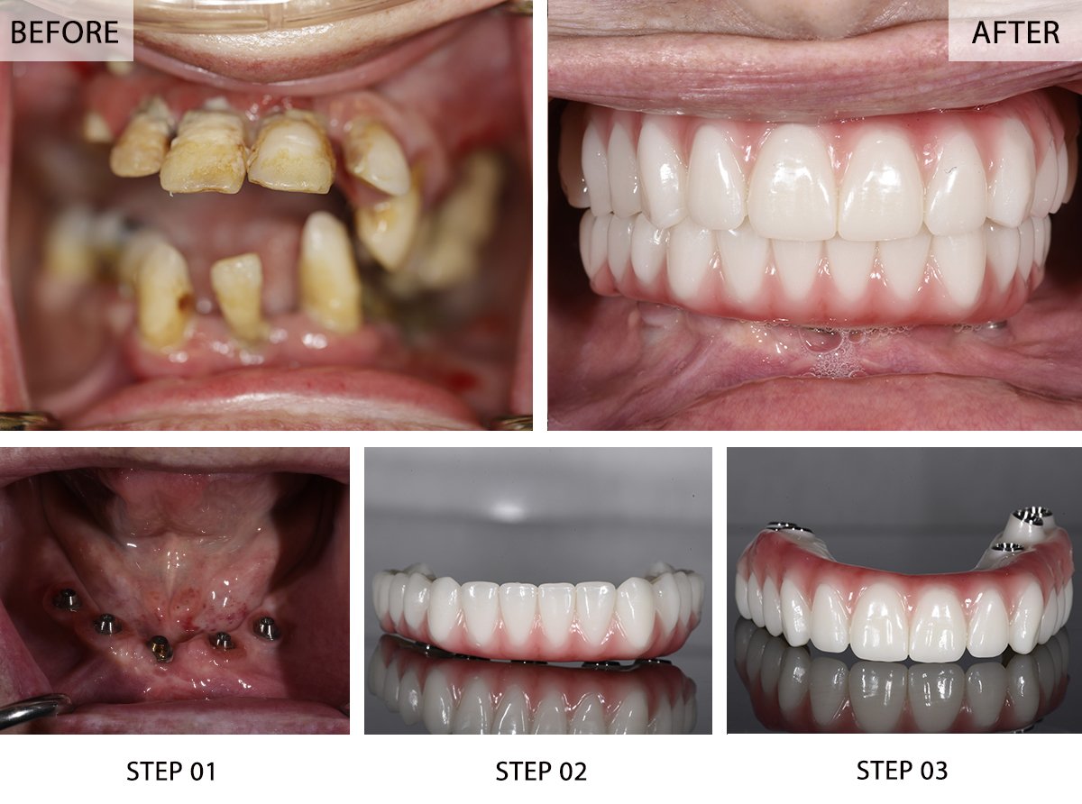 Illustrative example of full mouth dental implants before and after pictures from Google Search