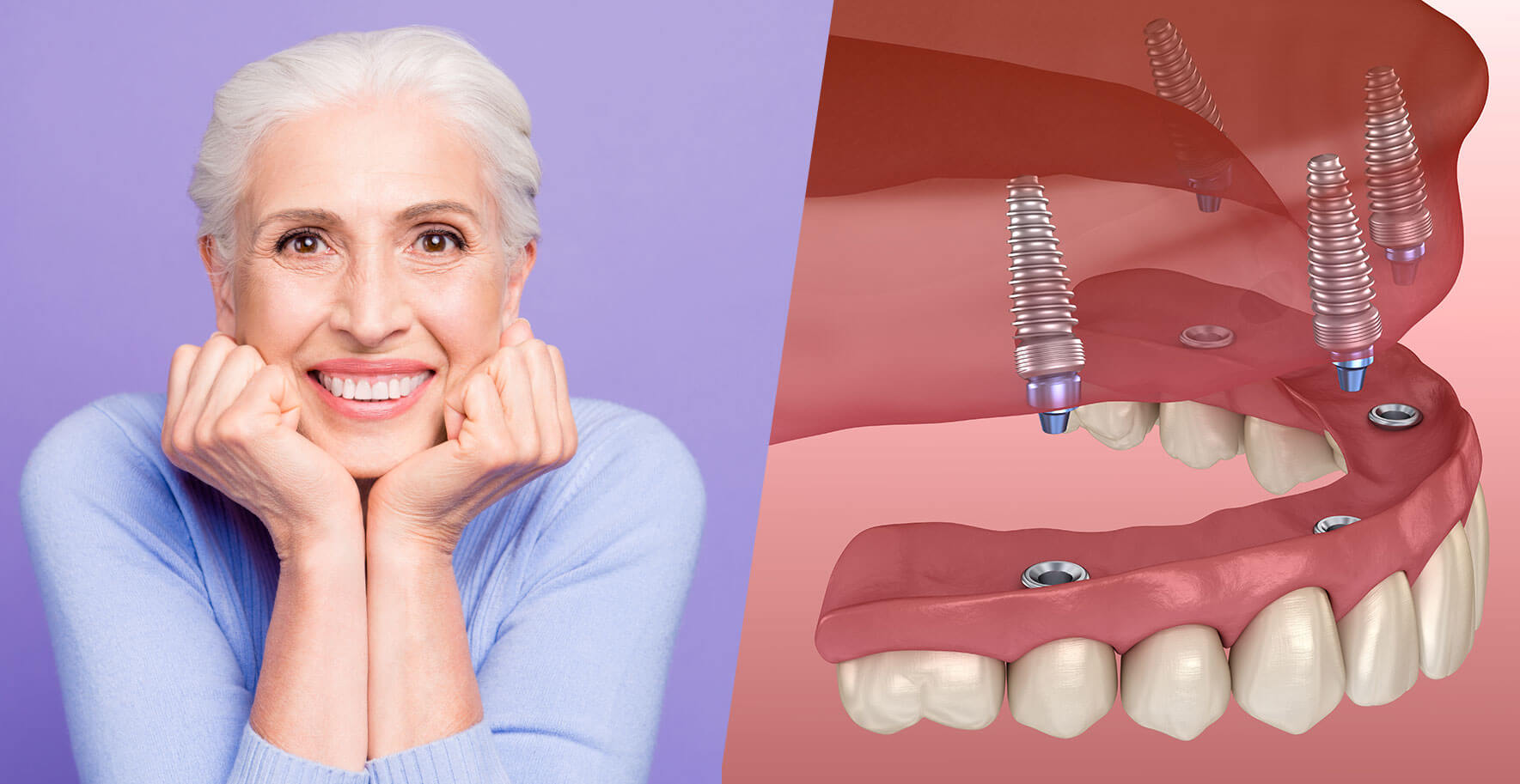 Illustrative example of full mouth of dental implants from Google Search