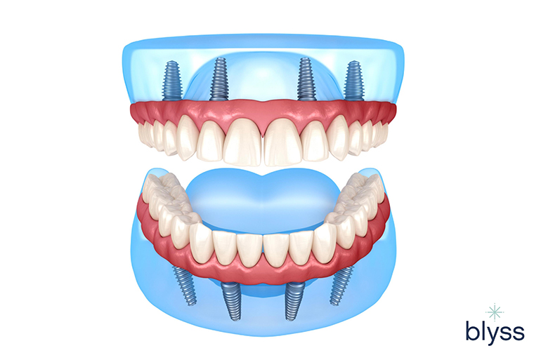 Illustrative example of full upper dental implants from Google Search